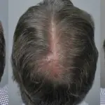 1 Dirham Hair Transplant in Dubai: Facts for Patients
