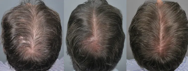 1 Dirham Hair Transplant in Dubai: Facts for Patients