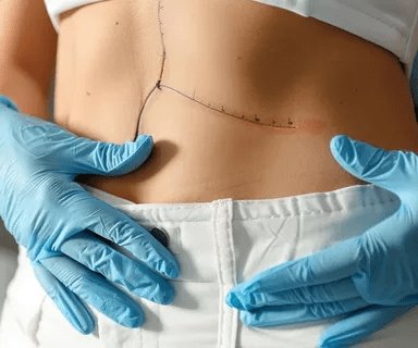 Tummy Tuck Surgery in Dubai: Enhancing Body Proportion Tummy Tuck Surgery in Dubai