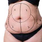 How Tummy Tuck in Islamabad Helps Tighten Loose Abdominal Skin