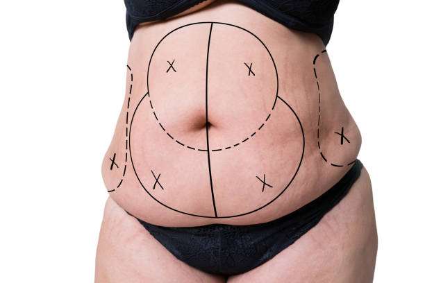How Tummy Tuck in Islamabad Helps Tighten Loose Abdominal Skin How Tummy Tuck in Islamabad Helps Tighten Loose Abdominal Skin
