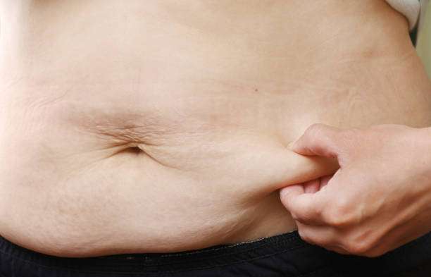 Benefits of Choosing a Tummy Tuck for Body Contouring in Riyadh