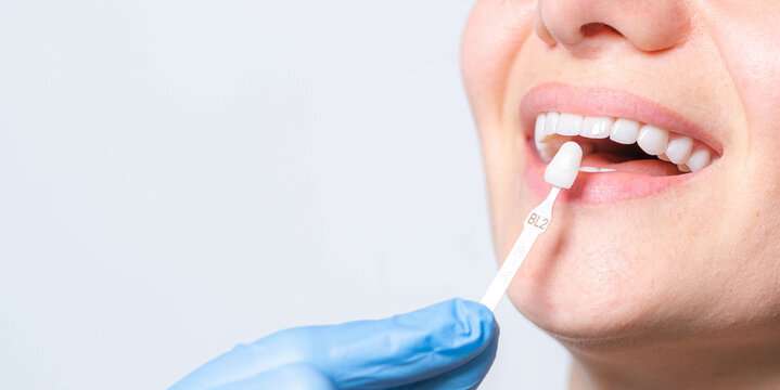 Veneers in Islamabad: The Secret to a Confident and Camera-Ready Look