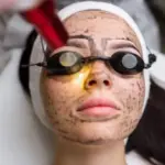 What Are the Benefits of Laser Carbon Peel?