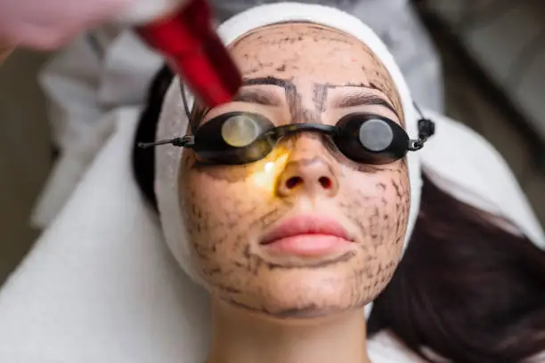 What Are the Benefits of Laser Carbon Peel? What Are the Benefits of Laser Carbon Peel?