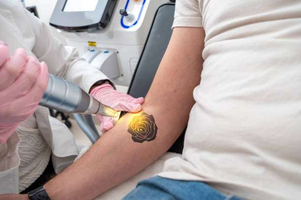 Tattoo Removal in Islamabad: What to Expect from Your Treatment Journey Tattoo Removal in Islamabad: What to Expect from Your Treatment Journey