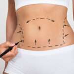 Liposuction Insights for Confident Decision Making Liposuction Insights for Confident Decision Making