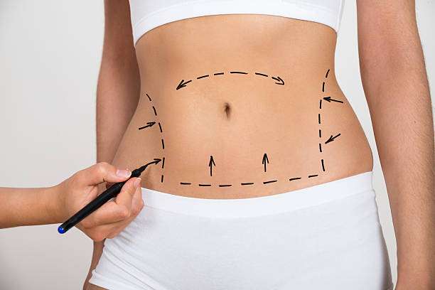 Liposuction Insights for Confident Decision Making Liposuction Insights for Confident Decision Making