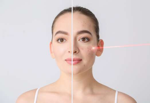 Laser Acne Scar Treatment in Riyadh for Smoother Complexion Improvement Laser Acne Scar Treatment in Riyadh for Smoother Complexion Improvement