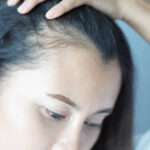 Exosomes Therapy for Hair Loss: Supporting Weak and Thinning Hair