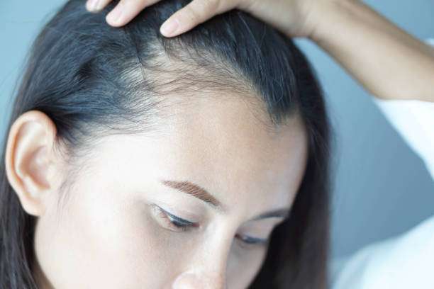 Exosomes Therapy for Hair Loss: Supporting Weak and Thinning Hair