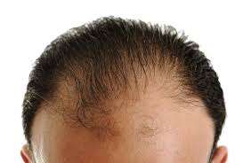 Hair Loss Treatment in Riyadh with Effective Solutions for Hair Renewal Hair Loss Treatment in Riyadh with Effective Solutions for Hair Renewal