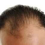 Hair Loss Treatment in Riyadh with Effective Solutions for Hair Renewal Hair Loss Treatment in Riyadh with Effective Solutions for Hair Renewal