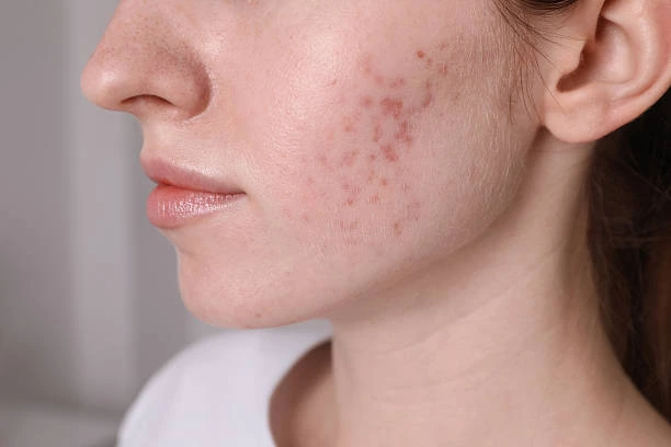 Is Acne Treatment Safe for Sensitive Skin Types?