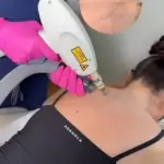 Is Laser Tattoo Removal Suitable for Dark Ink?