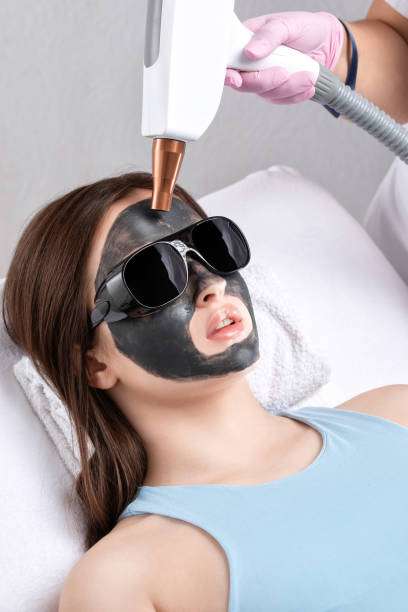 How Spectra Laser Carbon Peeling Helps Improve Skin Texture and Tone