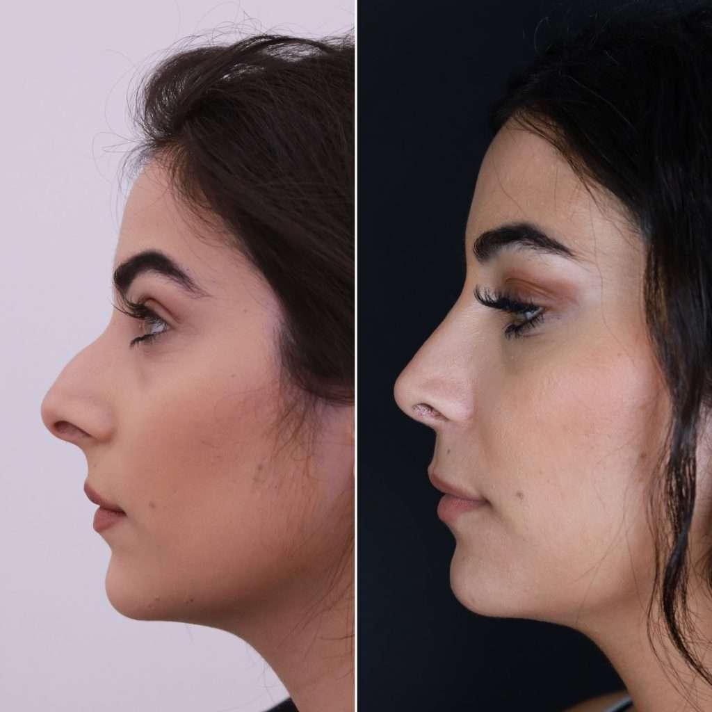 Rhinoplasty in Islamabad: The Facial Blueprint Method for Creating a Balanced Appearance