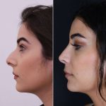 Rhinoplasty in Islamabad: The Facial Blueprint Method for Creating a Balanced Appearance