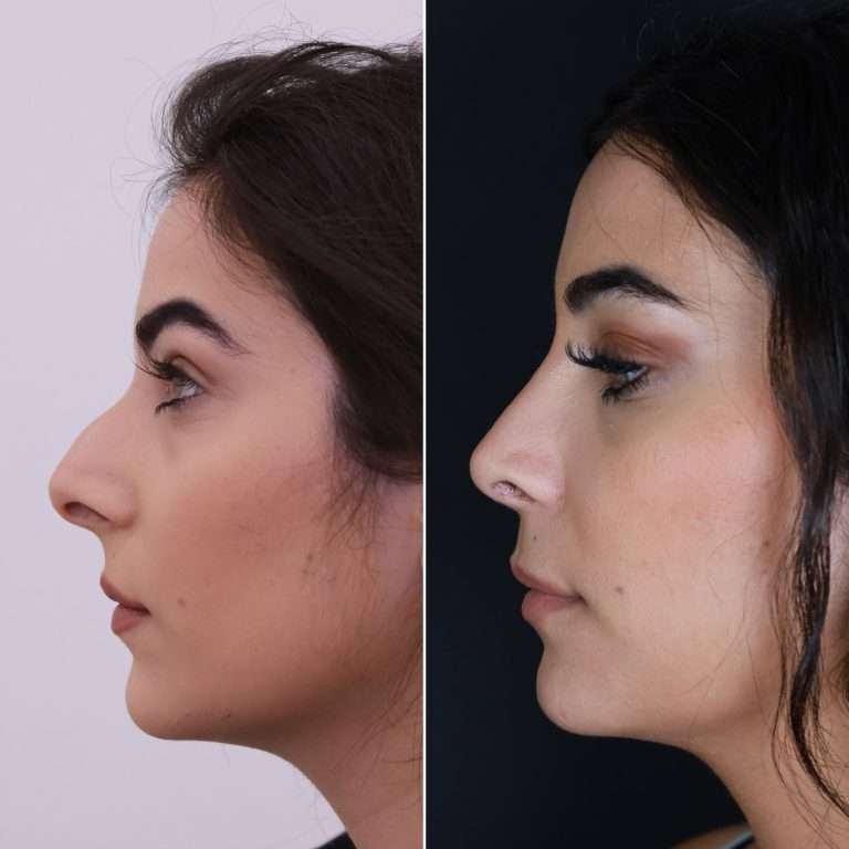 Rhinoplasty in Islamabad: The Facial Blueprint Method for Creating a Balanced Appearance Rhinoplasty in Islamabad: The Facial Blueprint Method for Creating a Balanced Appearance
