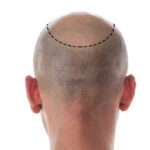 Hair Transplant Guide to Supporting Natural-Looking Hair Growth