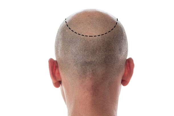Hair Transplant Guide to Supporting Natural-Looking Hair Growth