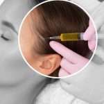 ACell PRP Treatment for Hair in Dubai Compared With Other Hair Restoration Options