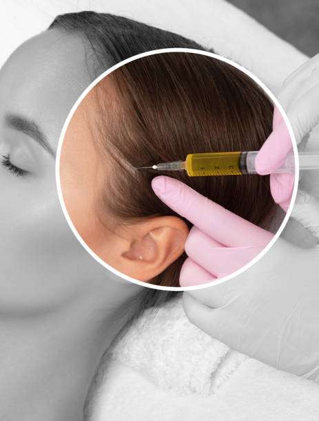ACell PRP Treatment for Hair in Dubai Compared With Other Hair Restoration Options ACell PRP Treatment for Hair in Dubai Compared With Other Hair Restoration Options