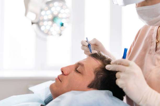 Hair Transplant in Al Ain for Receding Hairlines