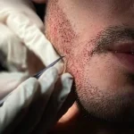 Is Beard Hair Transplant in Dubai a Permanent Solution?
