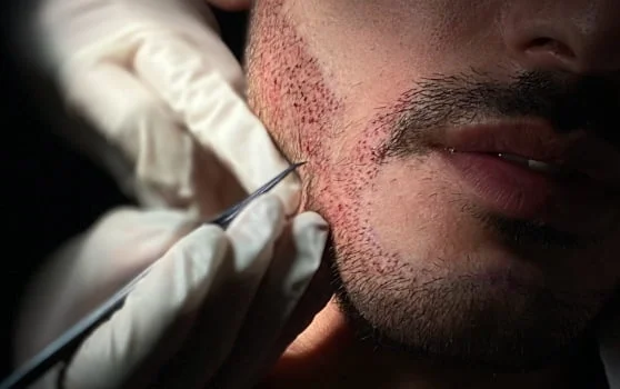 Is Beard Hair Transplant in Dubai a Permanent Solution? Is Beard Hair Transplant in Dubai a Permanent Solution?