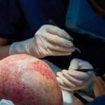 Crown Hair Transplant in Dubai: What It Is, How It Works & Results