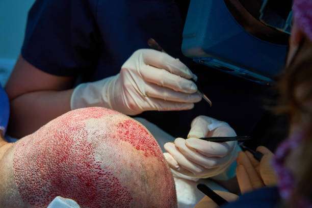 Crown Hair Transplant in Dubai: What It Is, How It Works & Results Crown Hair Transplant in Dubai: What It Is, How It Works & Results