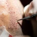 DHI Direct Hair Implant in Dubai for Fine and Low-Density Hair