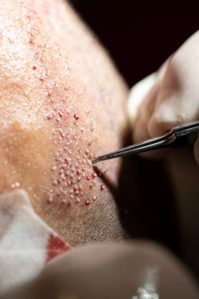DHI Direct Hair Implant in Dubai for Fine and Low-Density Hair DHI Direct Hair Implant in Dubai for Fine and Low-Density Hair
