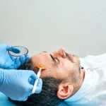 Why Choose Sideburn Hair Transplant in Dubai for Facial Hair Loss
