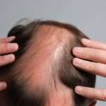 Can Stem Cell Hair Transplant in Dubai Restore Thinning Hair?