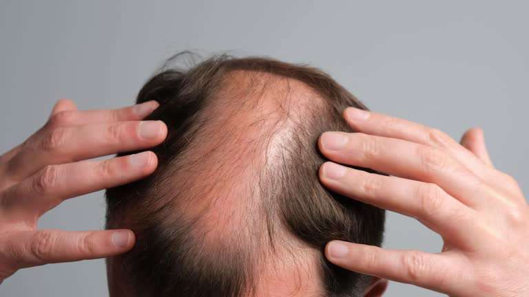 Can Stem Cell Hair Transplant in Dubai Restore Thinning Hair? Can Stem Cell Hair Transplant in Dubai Restore Thinning Hair?